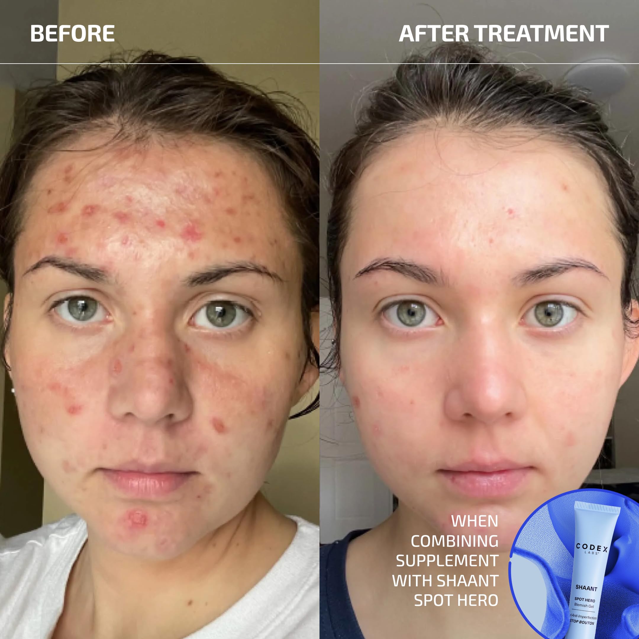 Codex Labs Shaant Clear Skin Supplement – 60 Vegan Capsules | Acne Probiotics with 9-Strain Blend, Green Tea EGCG & Guggul – Daily Support for Acne-Prone Skin & Clear Complexion Codex Labs buy supplements canada