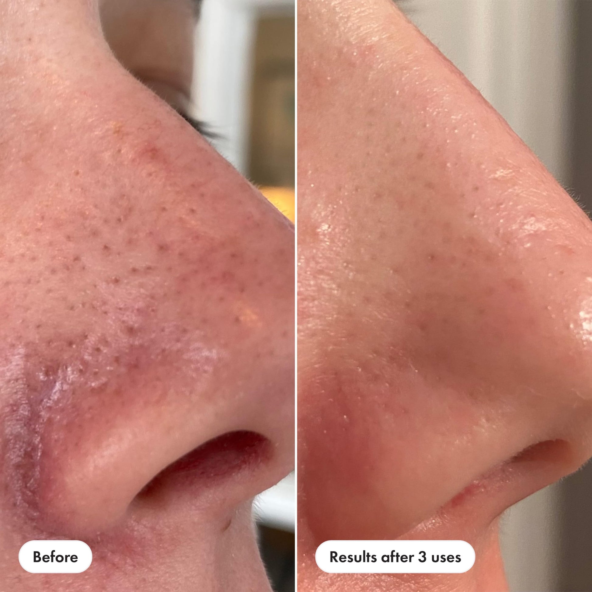 Hero Cosmetics Pore Release Blackhead Clearing Solution, Exfoliating 2% Salicylic Acid Toner Featuring AHA, BHA, and PHA HERO COSMETICS buy supplements canada