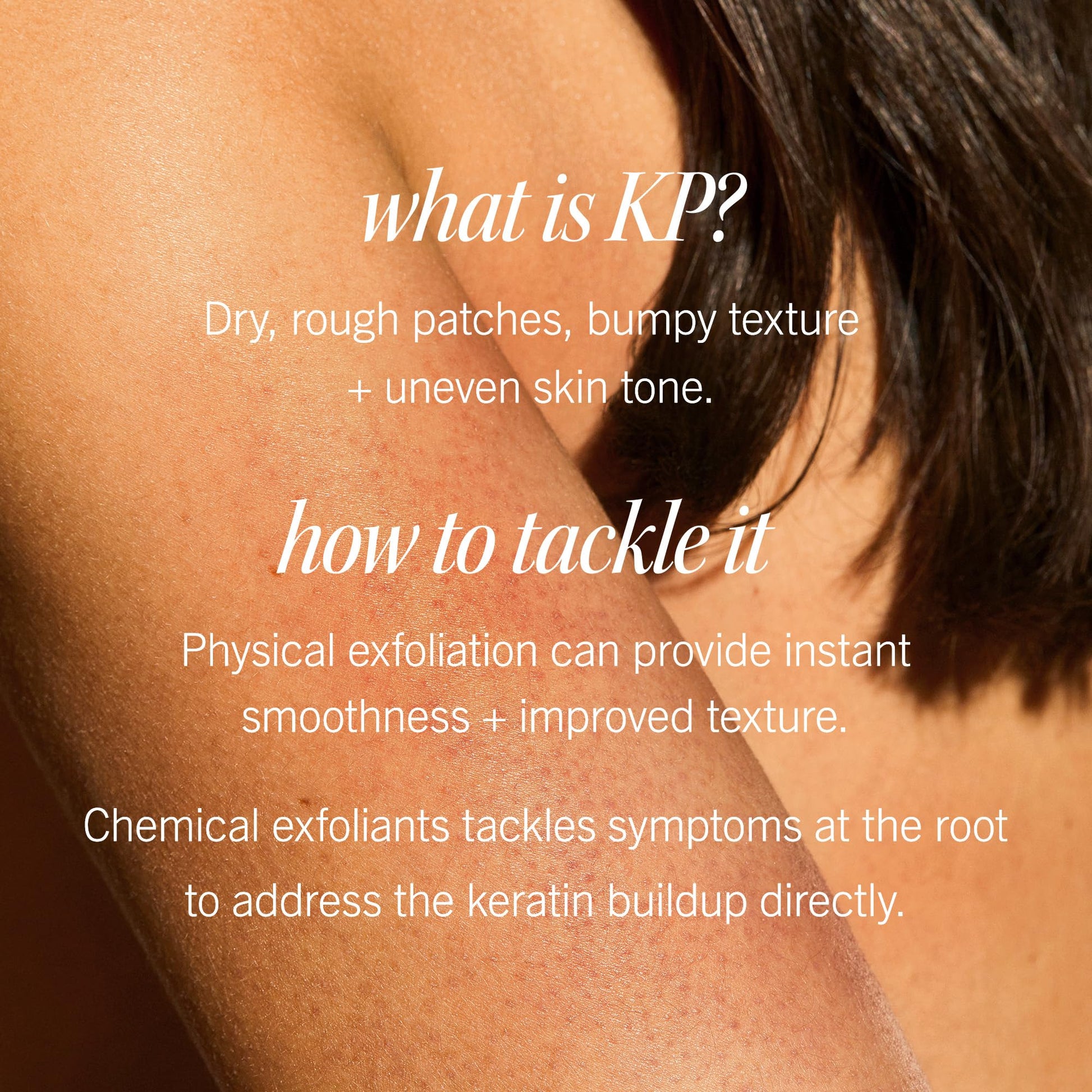 First Aid Beauty - KP Bump Eraser Body Scrub with 10% AHA, Keratosis Pilaris Exfoliator with Glycolic and Lactic acids, Helps Reduce Chicken Skin Bumps First Aid Beauty buy supplements canada