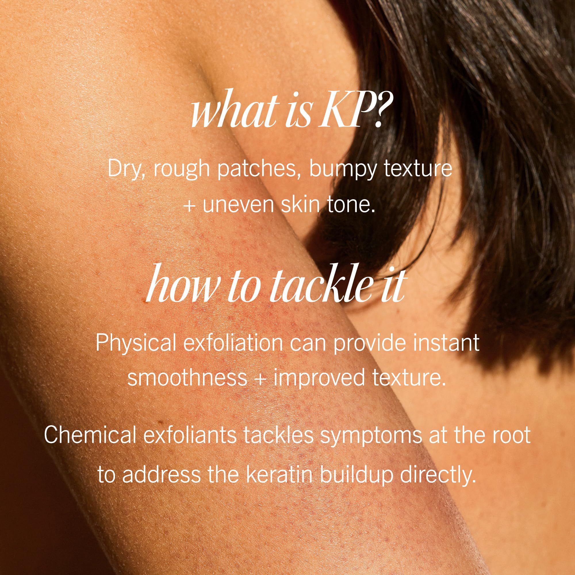 First Aid Beauty - KP Bump Eraser Body Scrub with 10% AHA, Keratosis Pilaris Exfoliator with Glycolic and Lactic acids, Helps Reduce Chicken Skin Bumps First Aid Beauty buy supplements canada